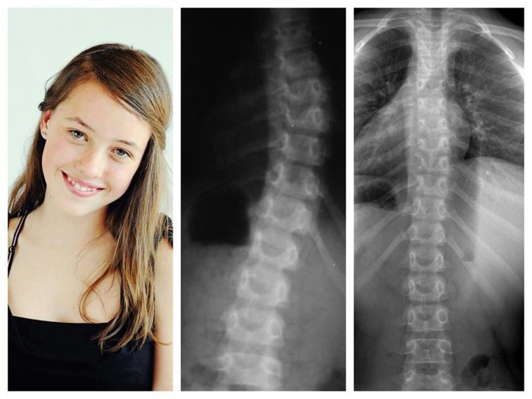 Skoliose? scoliosis.at